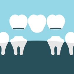 dental bridges services