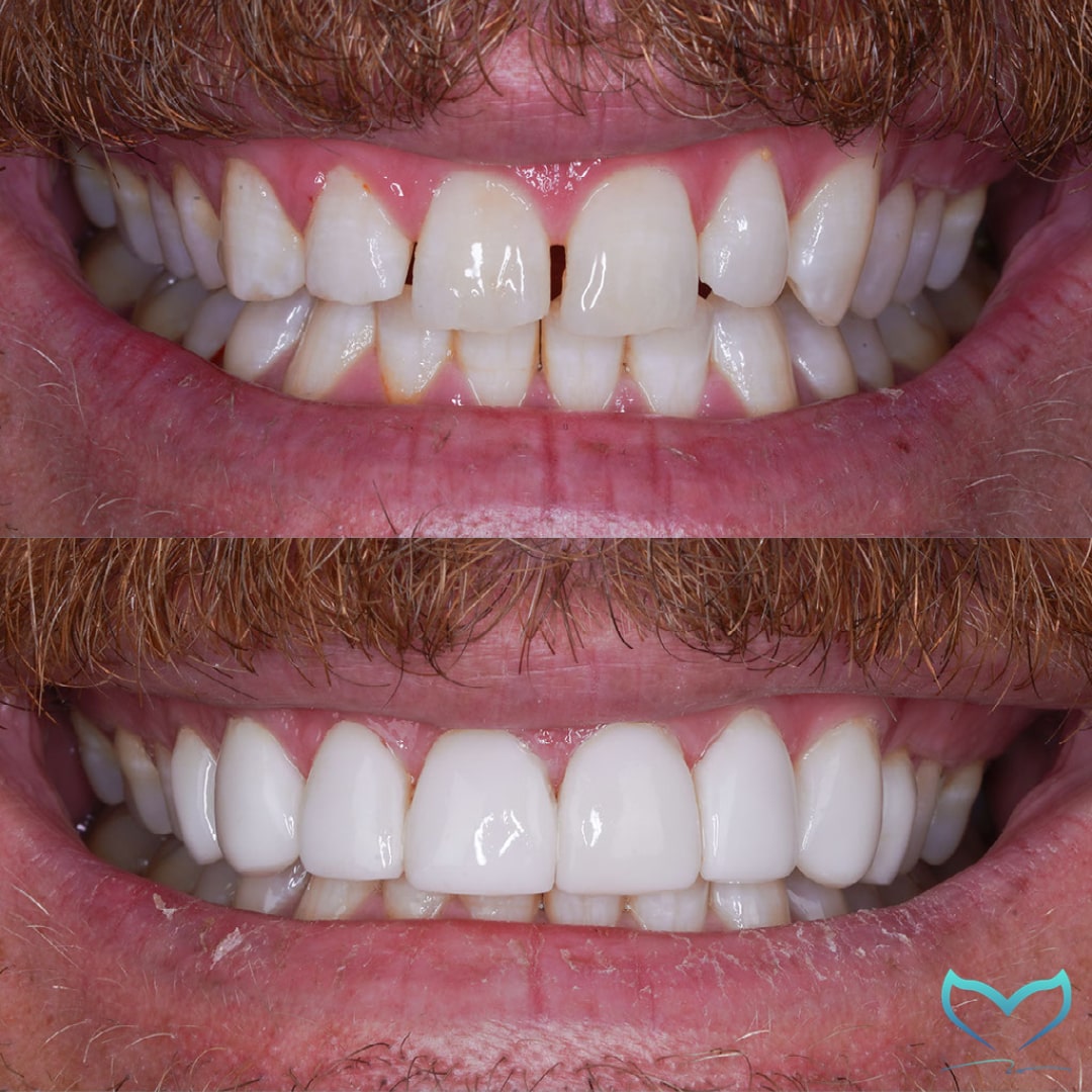 Before and After Dentist Gold Coast Cosmetic Dentist