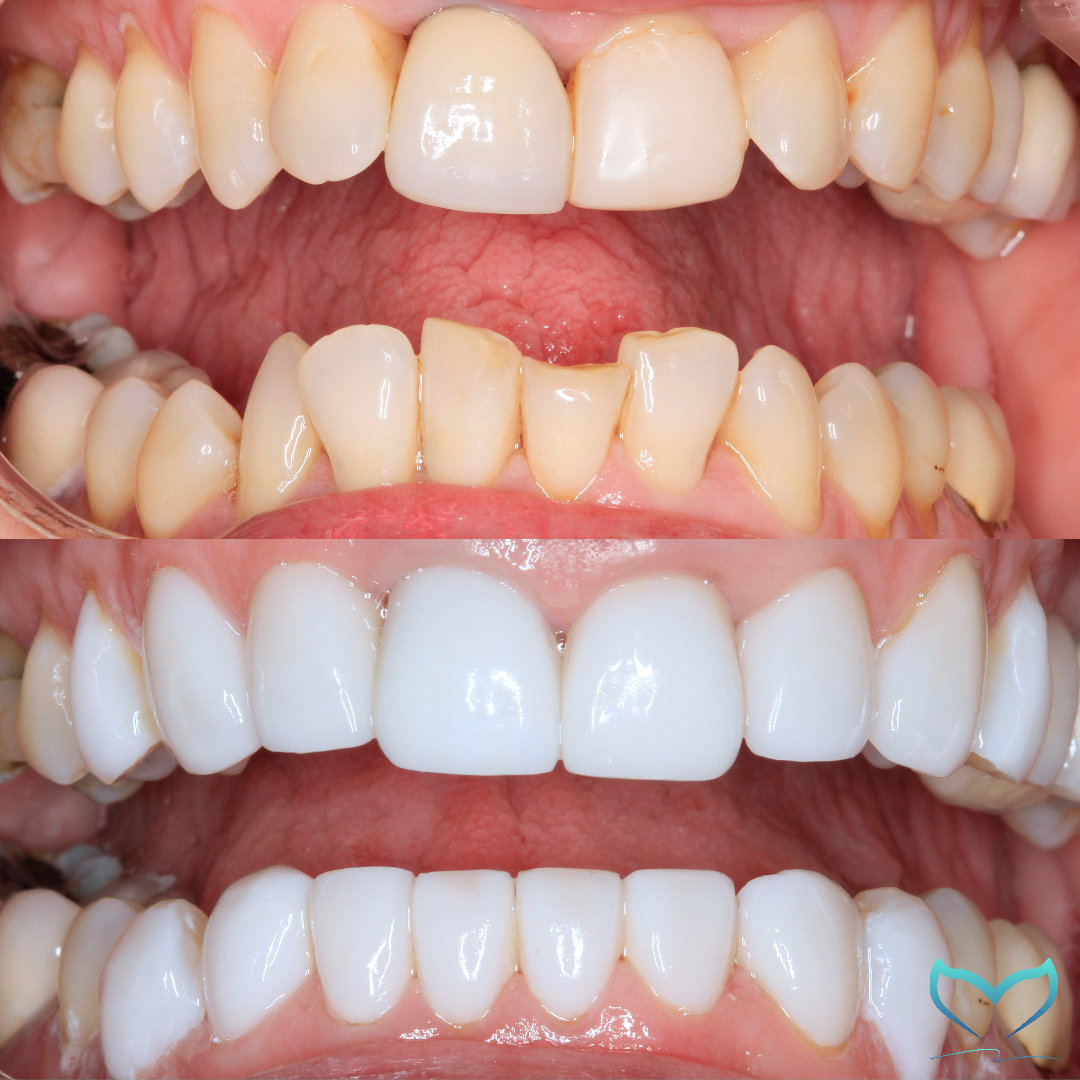 teeth whitening tricks