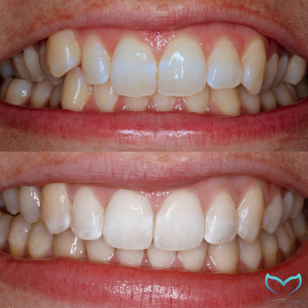 Before and After Dentist Gold Coast Cosmetic Dentist