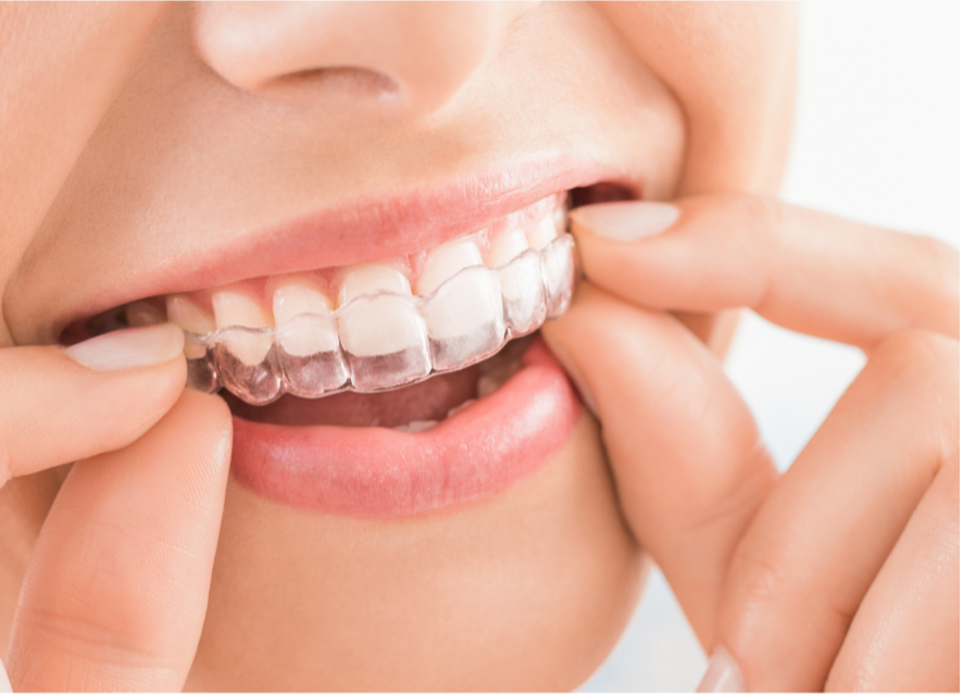 everything you need to know about invisalign