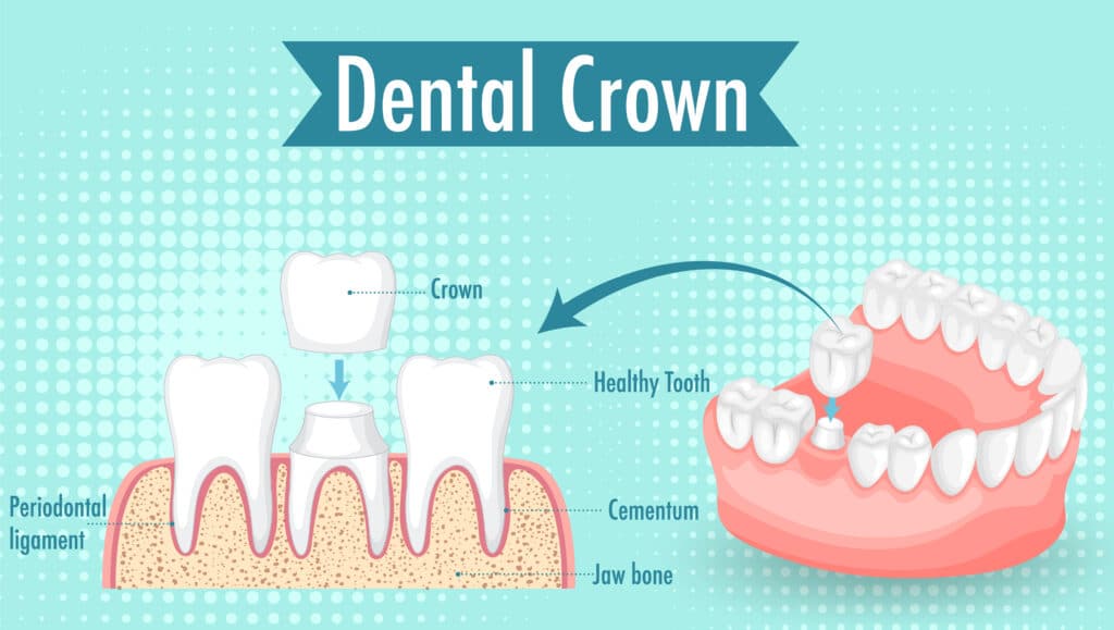 dental crown infographic