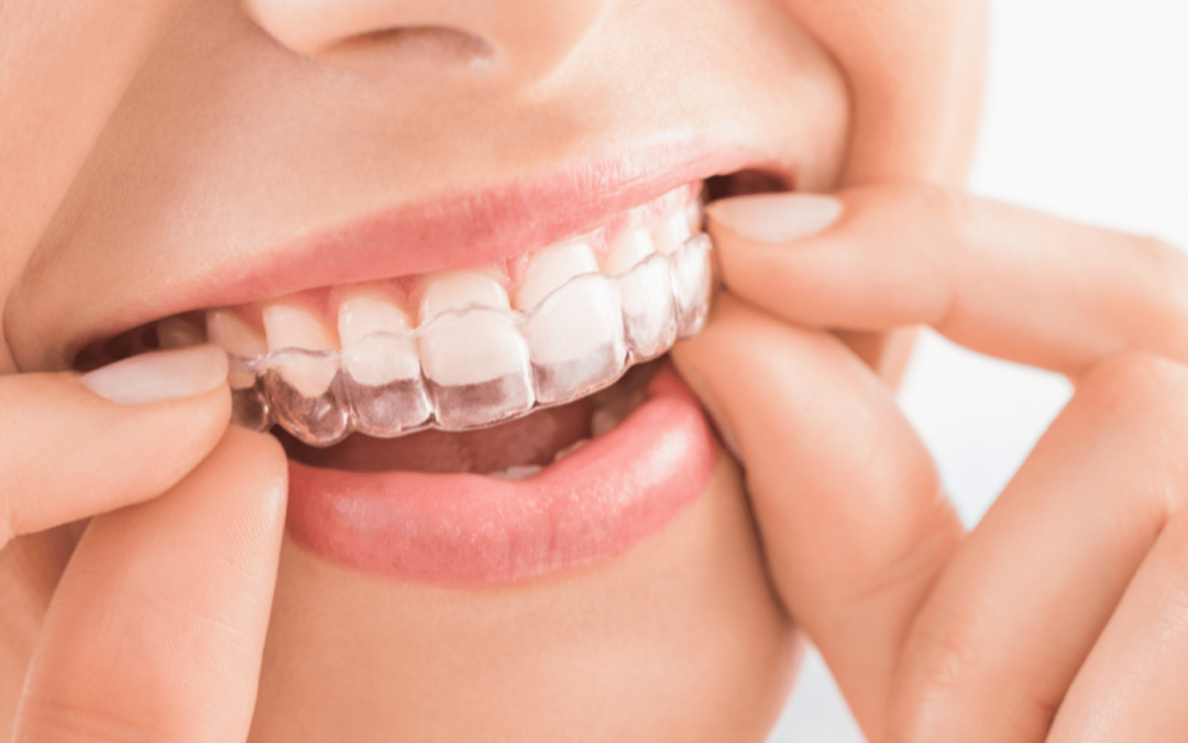 10 Invisalign Hacks Every Patient Should Know 