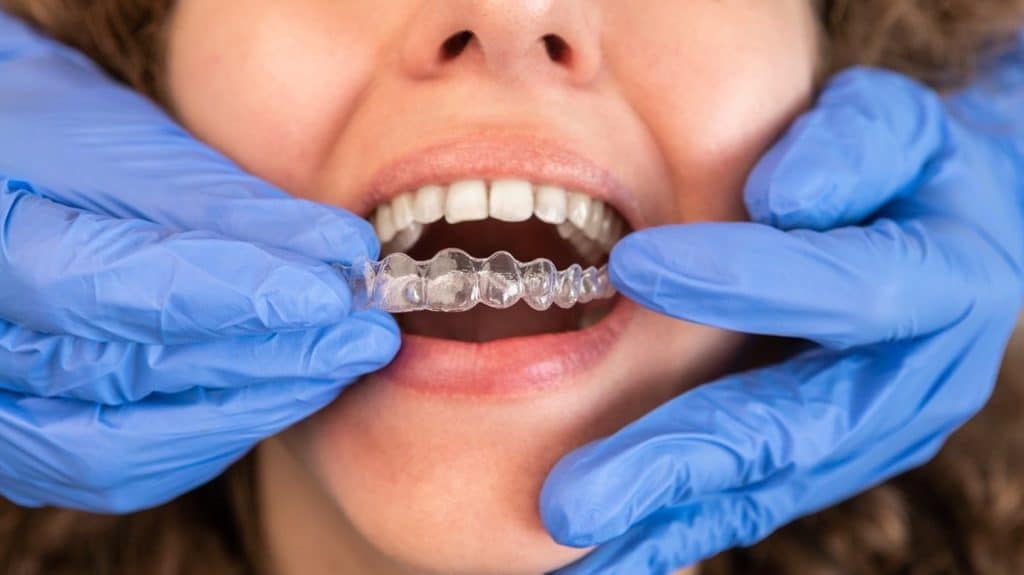 Invisalign Hack #3 Brush and Floss Frequently