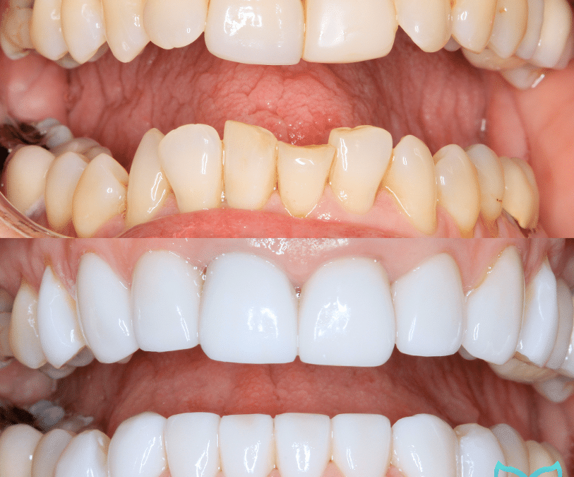 Veneers vs. Teeth Whitening: Which Is Right for You?